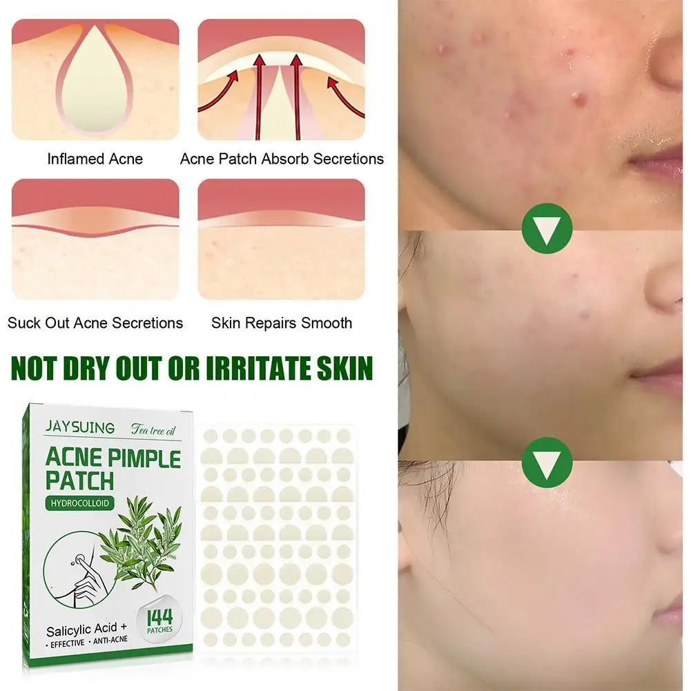 Acne pimple patch absorbing impurities and promoting clearer skin.